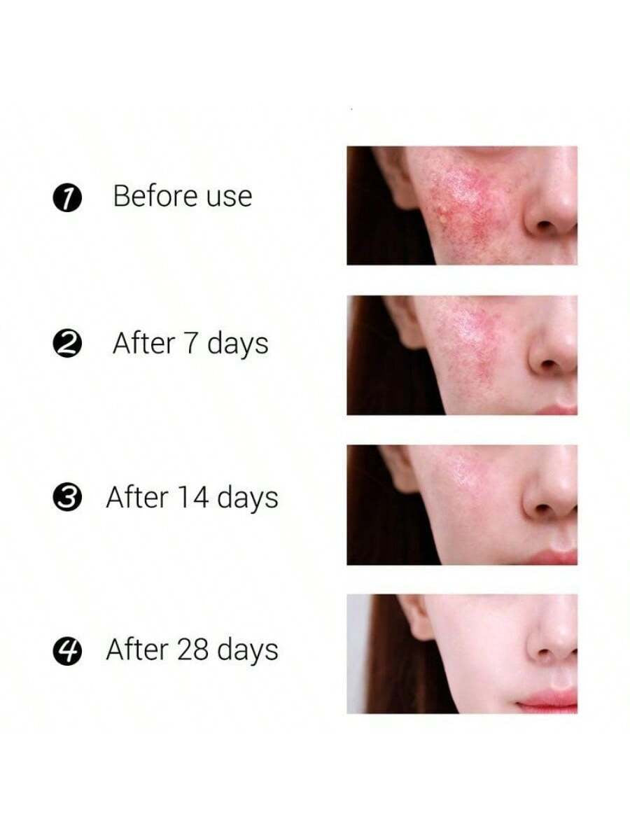 Best Whitening Herbal Tea Tree Oil Acne Spot Treatment Removing anti Acne Face Cream