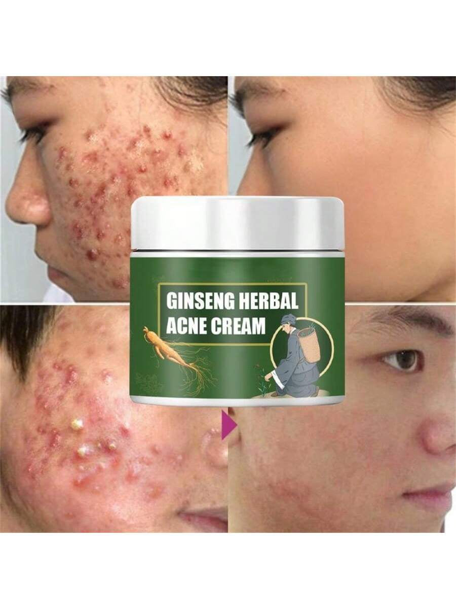 Effective Acne Removal Cream Treatment Acne Scar Shrink Pores Oil Control Whitening Moisturize Face