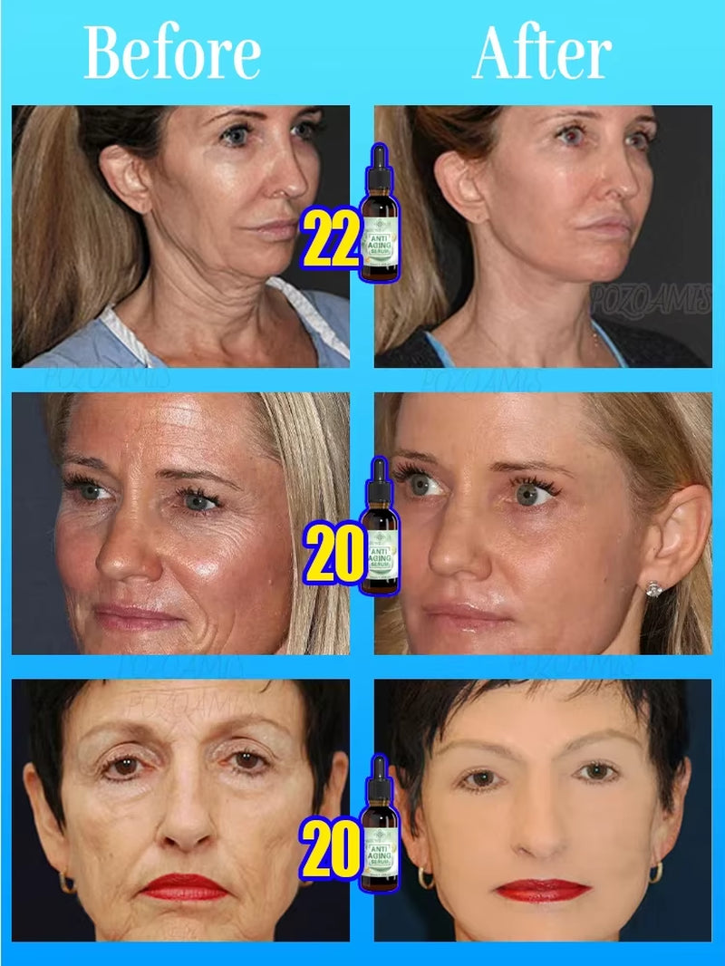 Wrinkles Disappear, the First Choice for Beauty Lovers