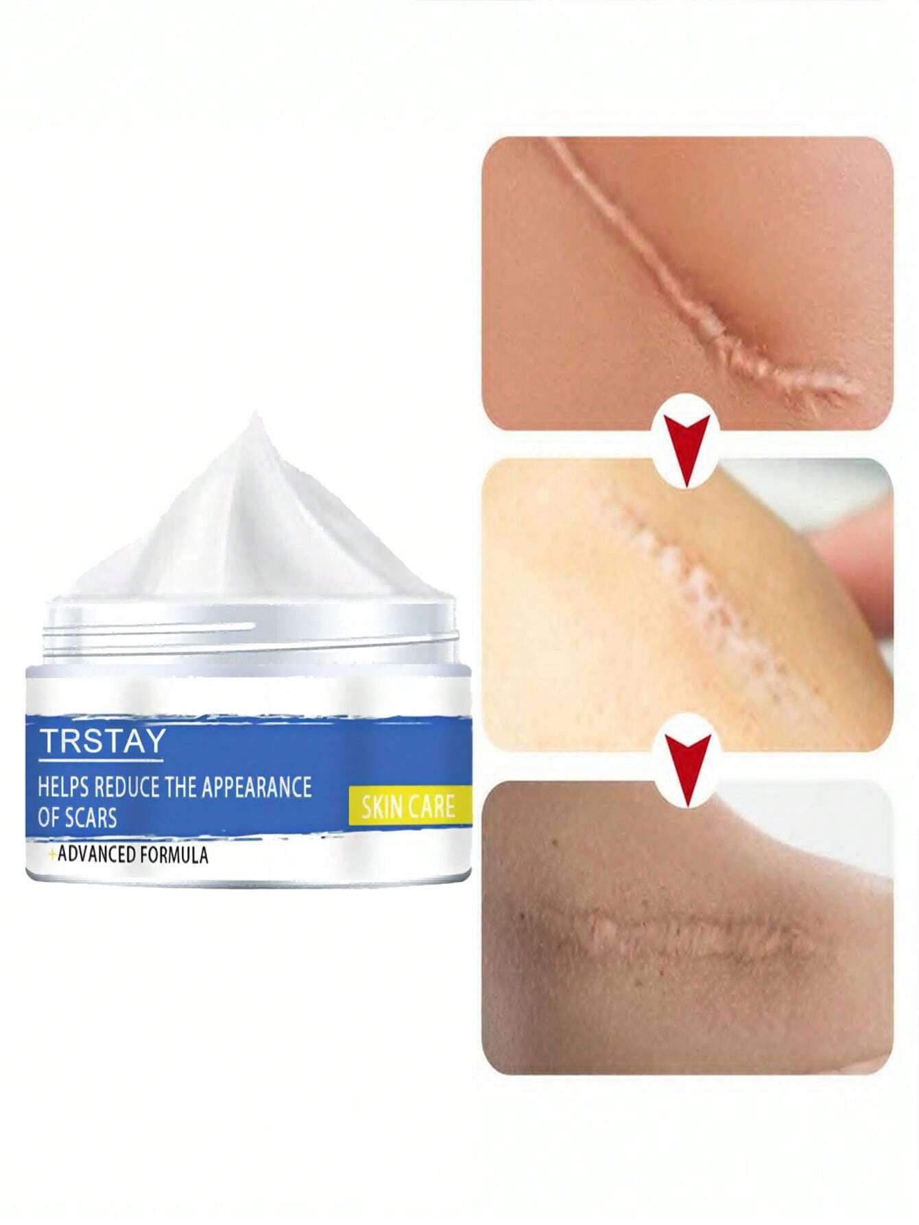 Deeply Permeate Cuticle Skin Care Acne Stretch Scar Cream , Scar Repair Cream to Lighten Scars Skincare Smooth Skin Care Cream