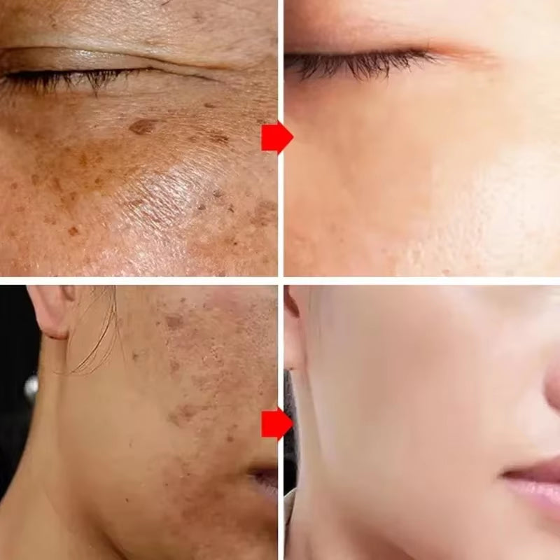 Astragalus Whitening Freckles Cream Face Dark Spots Remover Repair Products Removal Melasma Melanin Moisturiz Brighten Skin Care