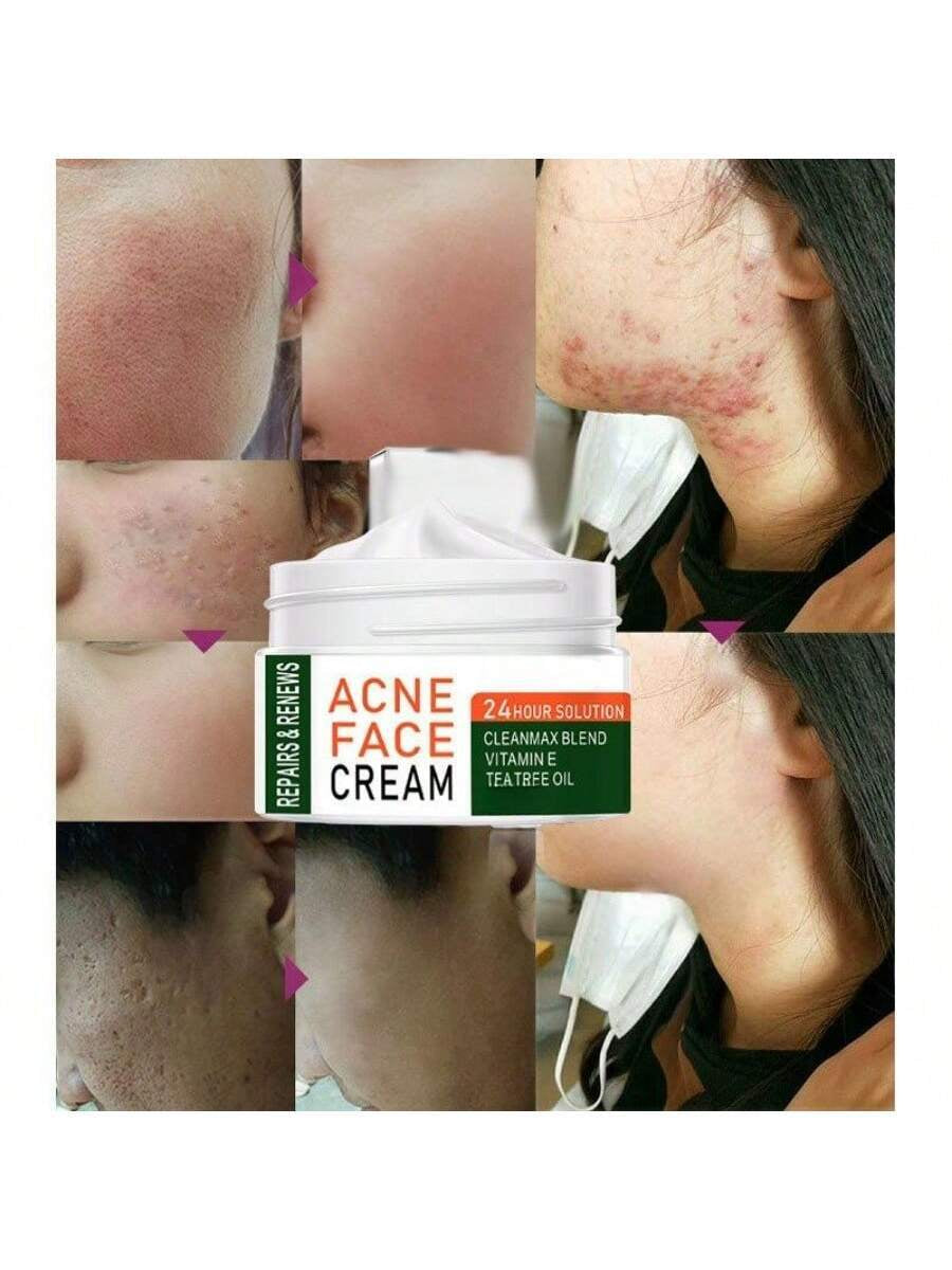 Best Whitening Herbal Tea Tree Oil Acne Spot Treatment Removing anti Acne Face Cream