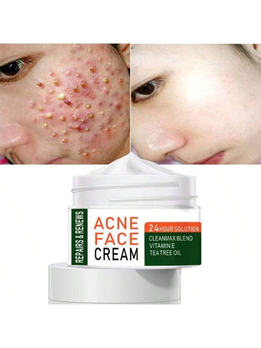 Best Whitening Herbal Tea Tree Oil Acne Spot Treatment Removing anti Acne Face Cream