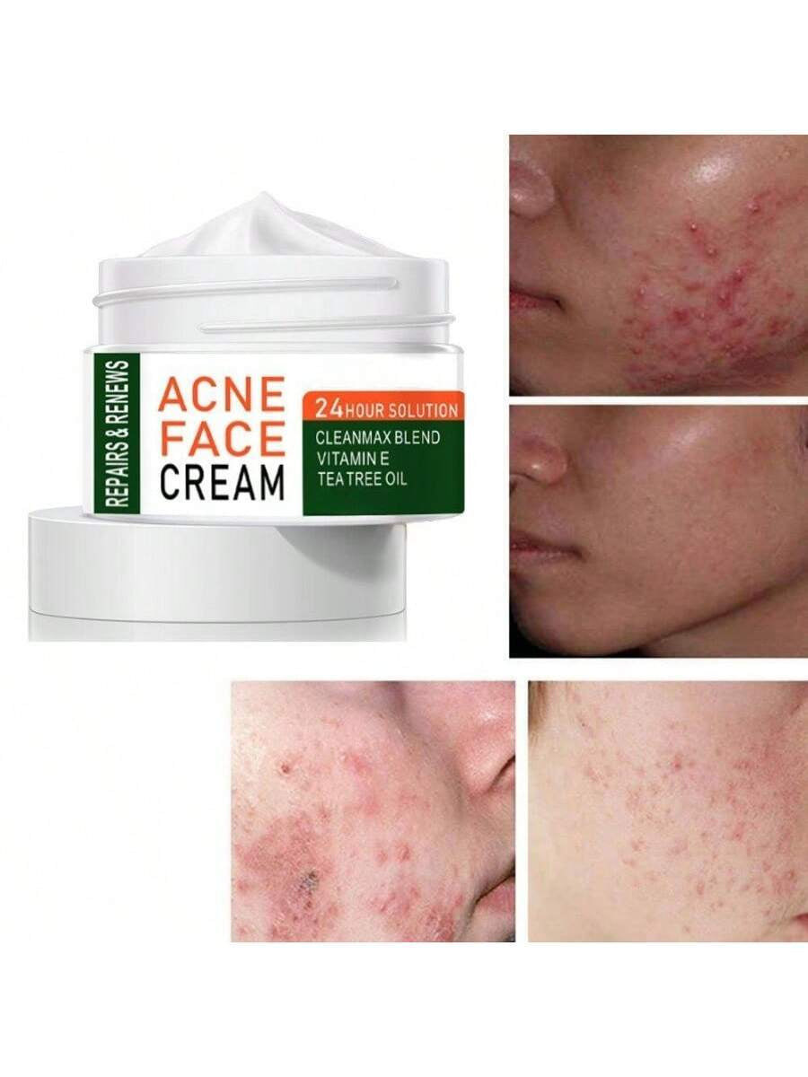 Best Whitening Herbal Tea Tree Oil Acne Spot Treatment Removing anti Acne Face Cream